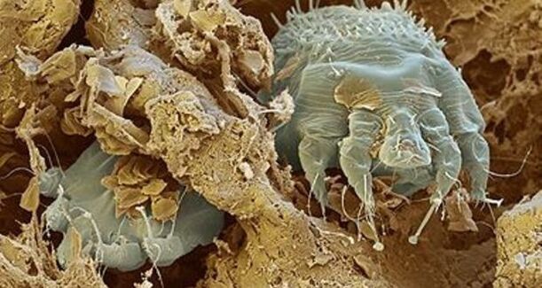 Mite scabies